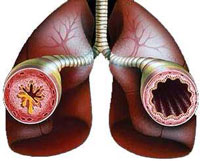 бронхиальная астма фото